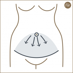 Schnitt und Straffung bei der Abdominoplastik