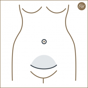 Schnitt und Straffung bei der Miniabdominoplastik